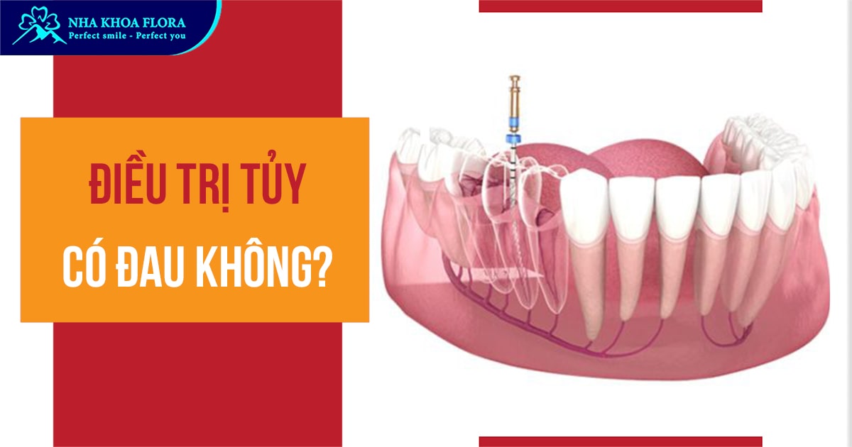 Điều trị tủy có đau không? Cảm giác diệt tủy răng thế nào?