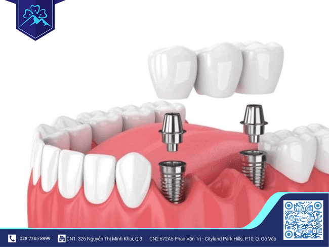 Phương pháp trồng răng Implant khắc phục tình trạng gãy 3 răng trong cùng