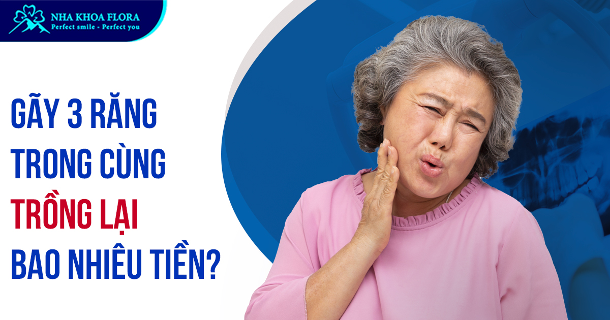 Gãy 3 răng trong cùng trồng lại hết bao nhiêu tiền?