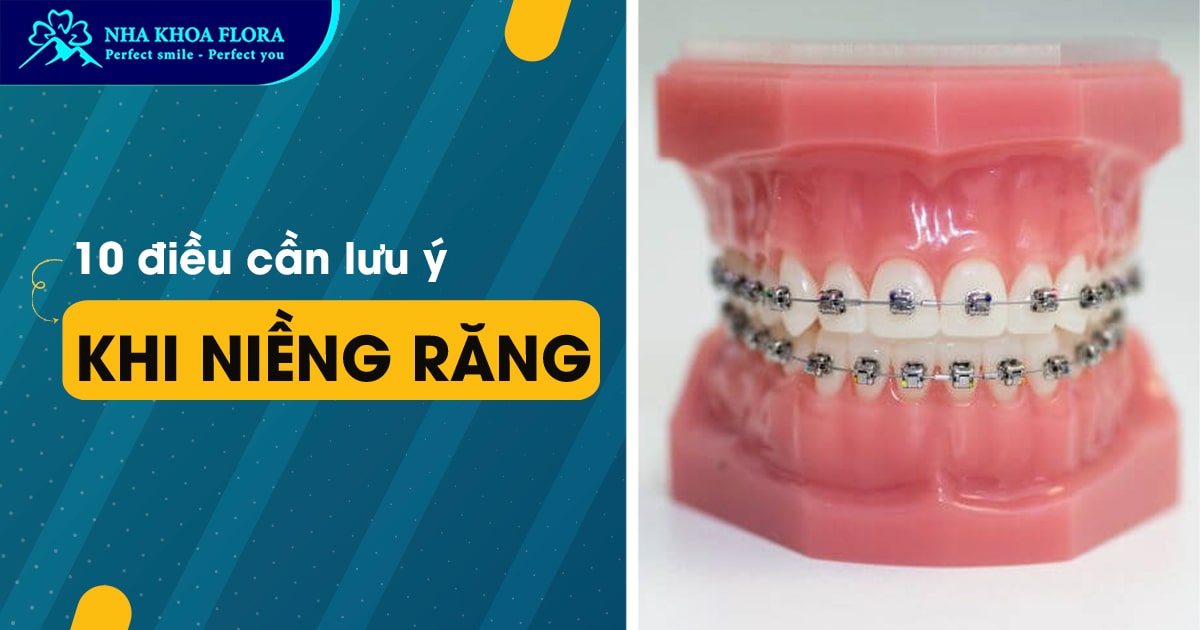 10 điều cần lưu ý khi niềng răng mà bạn không nên bỏ qua