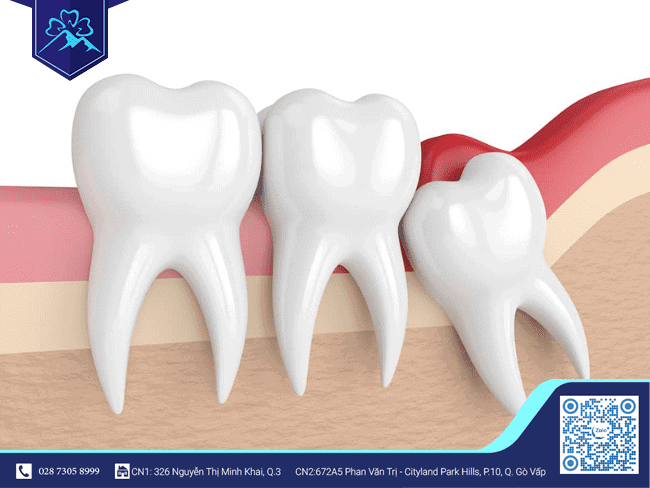 Răng khôn là chiếc răng mọc sau cùng của chúng ta, và chúng thường gây ra rất nhiều biến chứng