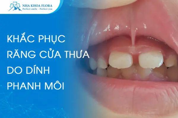 Điều trị răng cửa thưa do dính phanh môi 3