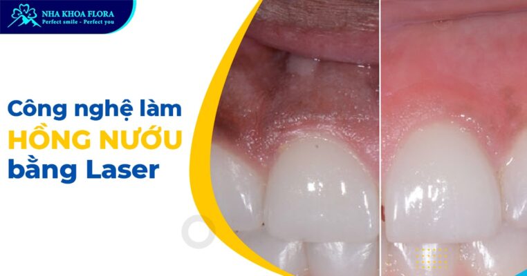 làm hồng nướu bằng Laser