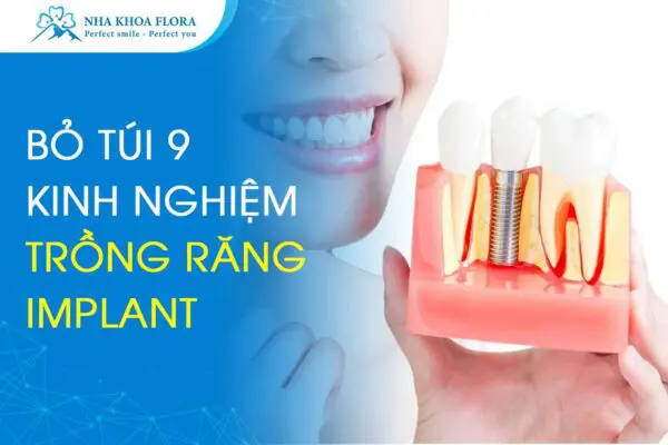 Bỏ Túi 9 Kinh Nghiệm Trồng Răng Implant Hiệu Quả 6