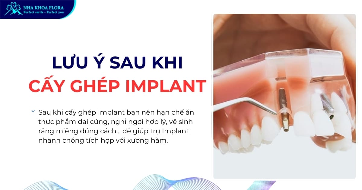 10 lưu ý sau khi cấy ghép Implant bạn nên biết