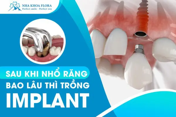 [Hỏi Đáp]: Sau Khi Nhổ Răng Bao Lâu Thì Trồng Implant? 2