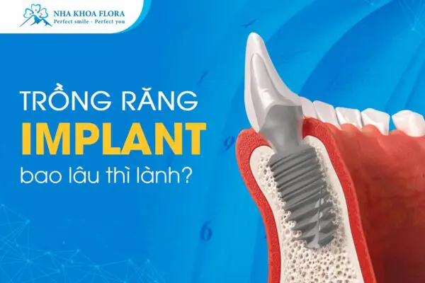 Hỏi Đáp: Trồng Răng Implant Bao Lâu Thì Lành? 3