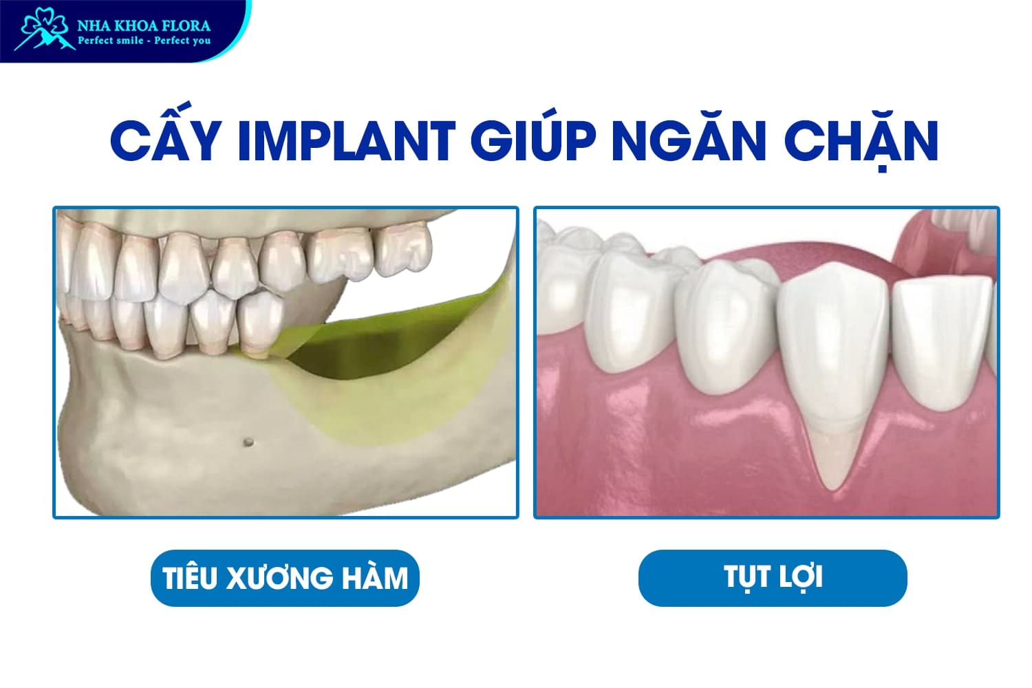 Hỏi Đáp: Trồng Răng Implant Có Vĩnh Viễn Không? - ảnh 2
