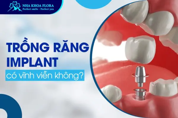 Hỏi Đáp: Trồng Răng Implant Có Vĩnh Viễn Không? 1