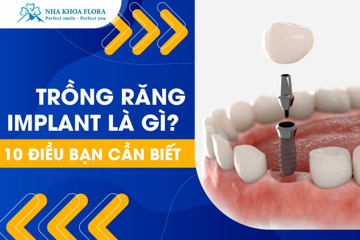 Trồng Răng Implant Là Gì? 10 Điều Cần Biết Trước Khi Thực Hiện