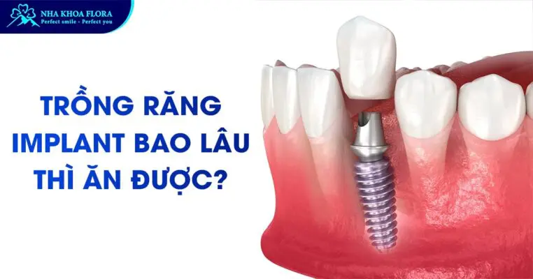 [Hỏi Đáp]: Trồng Răng Implant Bao Lâu Thì Ăn Được? 7