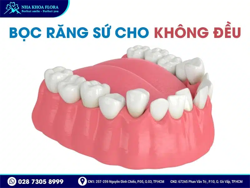 Khi nào nên bọc răng sứ - ảnh 3 Khi nào nên bọc răng sứ - ảnh 3