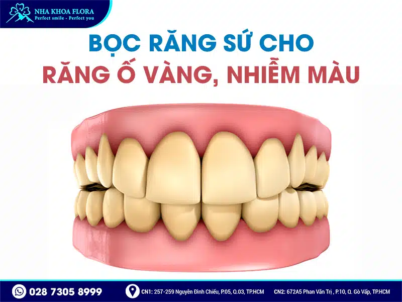 Khi nào nên bọc răng sứ - ảnh 5 Khi nào nên bọc răng sứ - ảnh 5