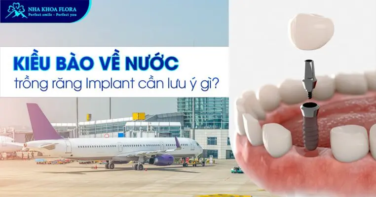 Kiều Bào về nước trồng răng Implant cần lưu ý gì? 4