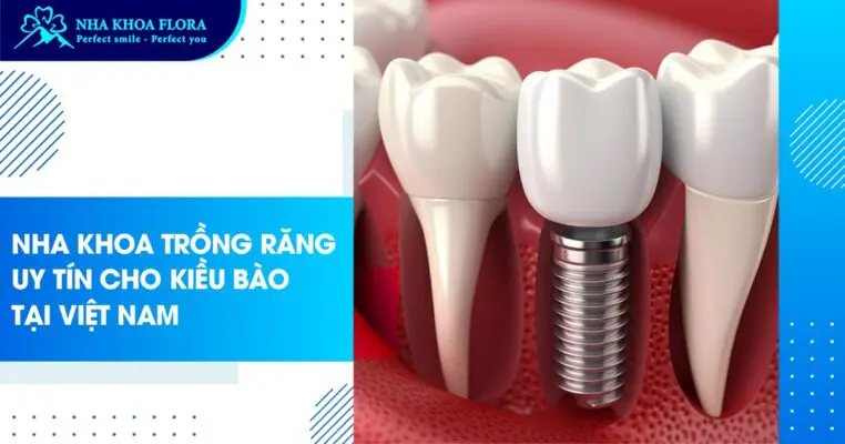 Nha khoa trồng răng uy tín cho Kiều Bào tại Việt Nam 3