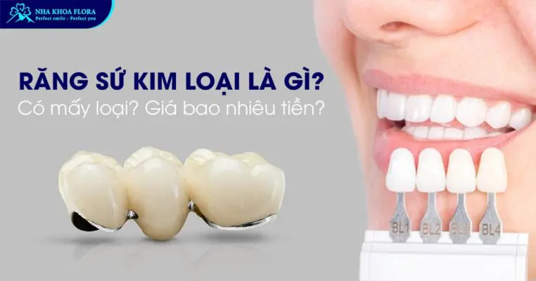Răng Sứ Kim Loại Là Gì? Có Mấy Loại? Giá Bao Nhiêu? 3