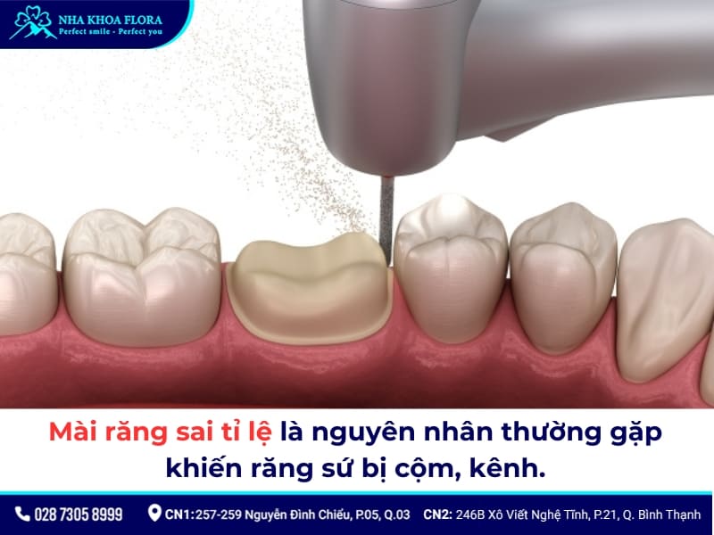bọc răng sứ bị lệch khớp cắn