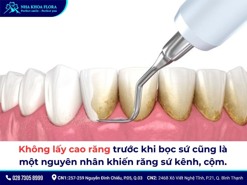 bọc răng sứ bị lệch khớp cắn