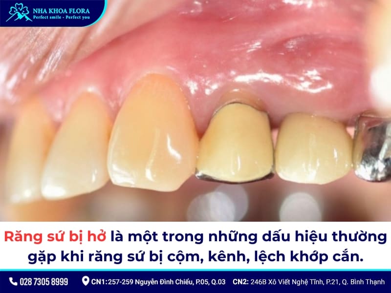 bọc răng sứ bị lệch khớp cắn