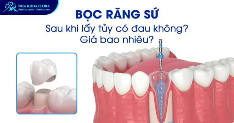 Bọc Răng Sứ Sau Khi Lấy Tủy Có Đau Không? Giá Bao Nhiêu? 7