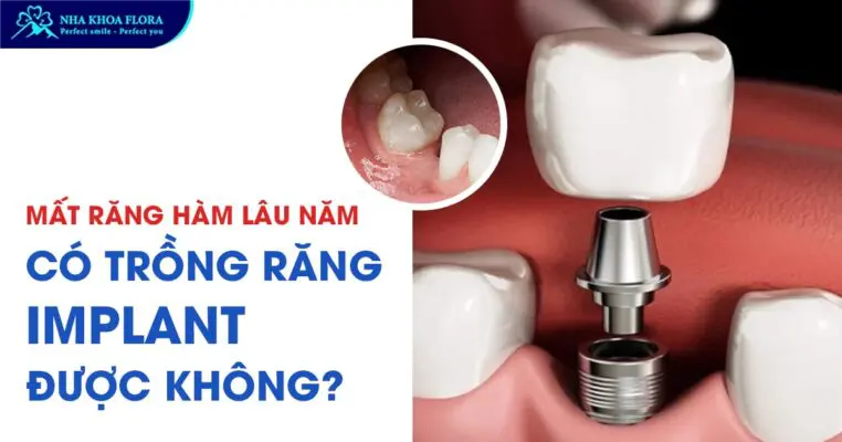 Mất răng hàm lâu năm có trồng răng Implant được không? 5