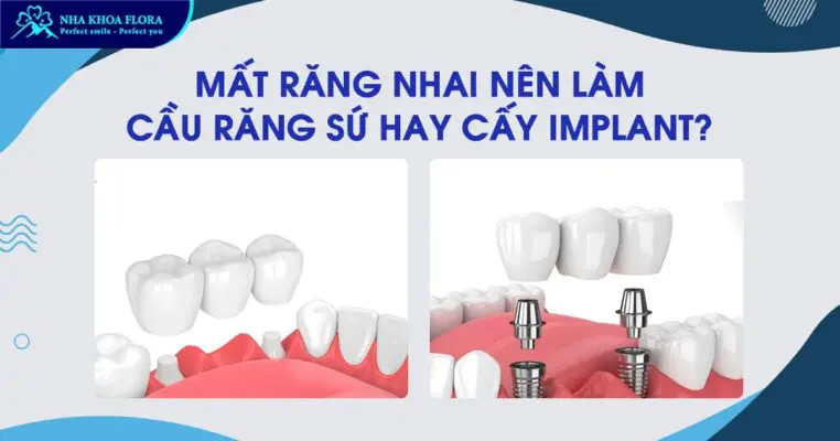 Mất răng nhai nên trồng răng Implant hay bắc cầu răng sứ? 6