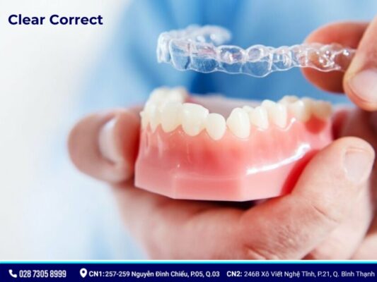 niềng răng trong suốt - ảnh 5 niềng răng trong suốt - ảnh 5