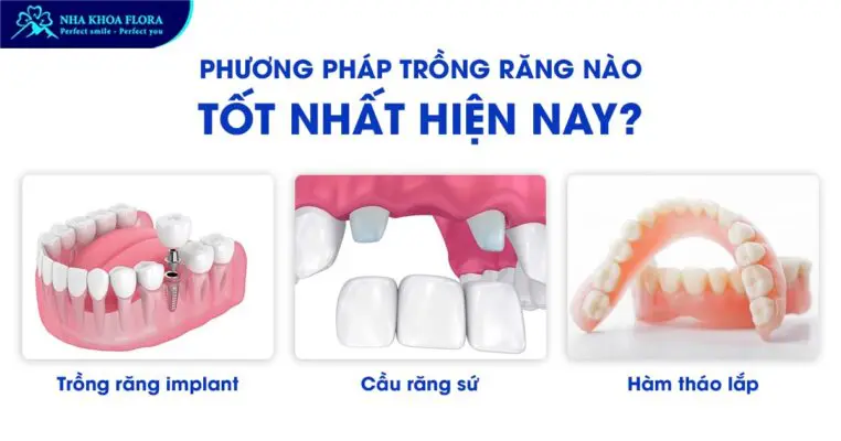 Trồng răng giả loại nào tốt? Giá bao nhiêu tiền? 4