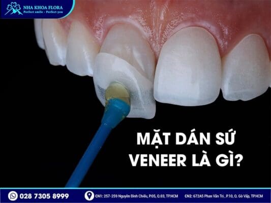 dán sứ Veneer - ảnh 1 dán sứ Veneer - ảnh 1
