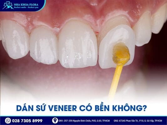 dán sứ Veneer - ảnh 2 dán sứ Veneer - ảnh 2