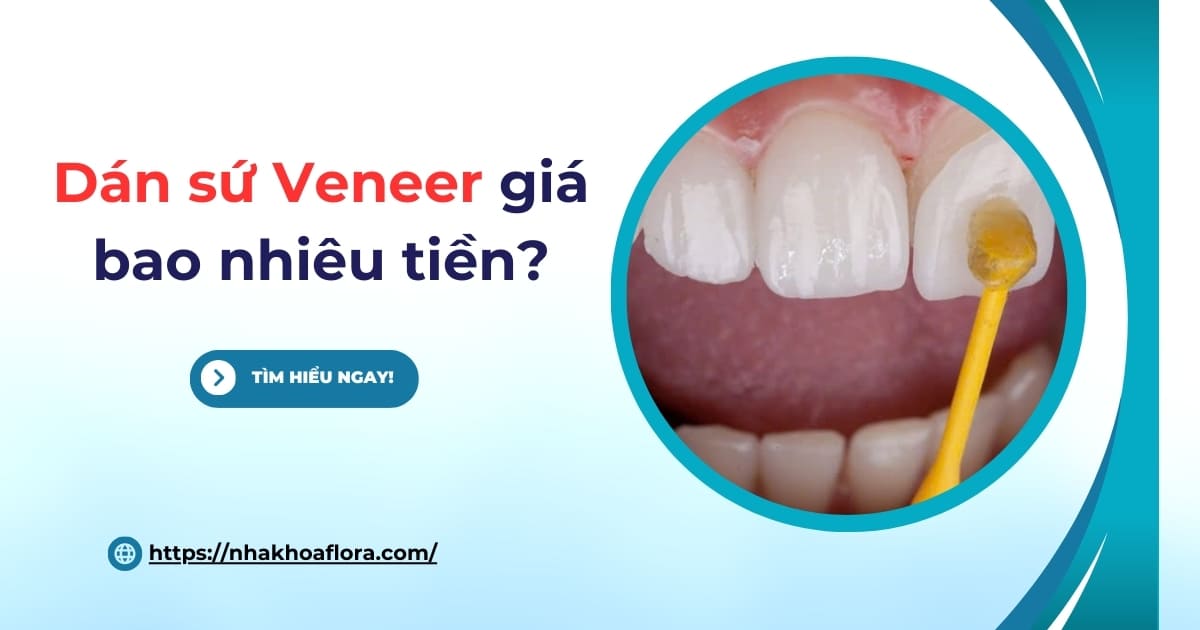 Dán sứ Veneer giá bao nhiêu tiền? Cập nhật bảng giá mới nhất