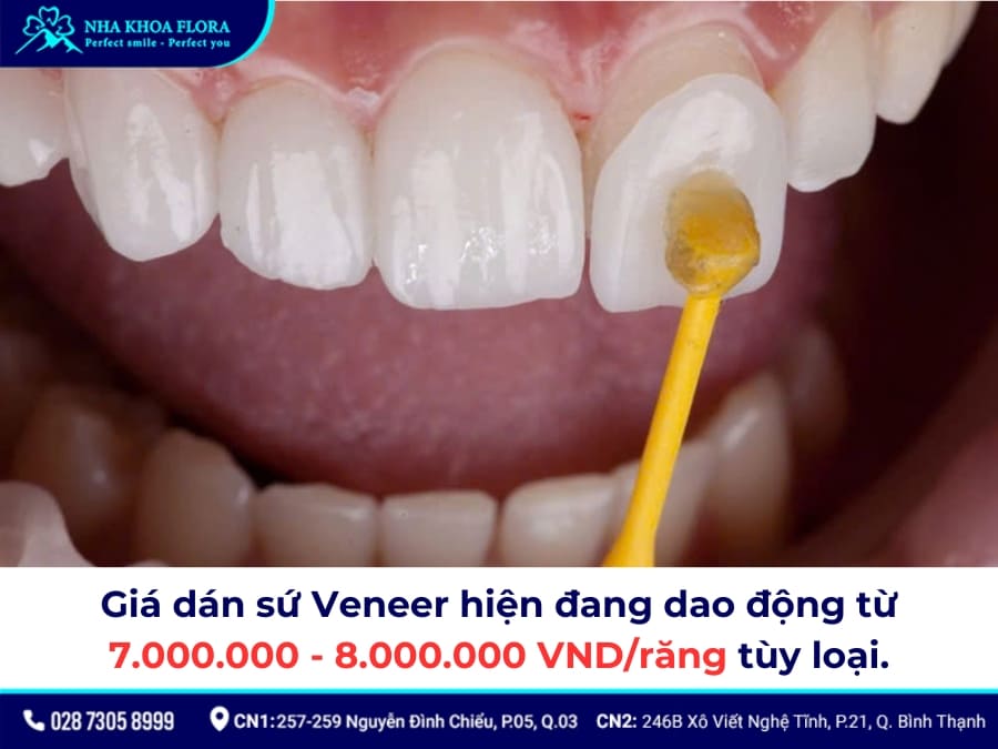 dán sứ veneer giá bao nhiêu