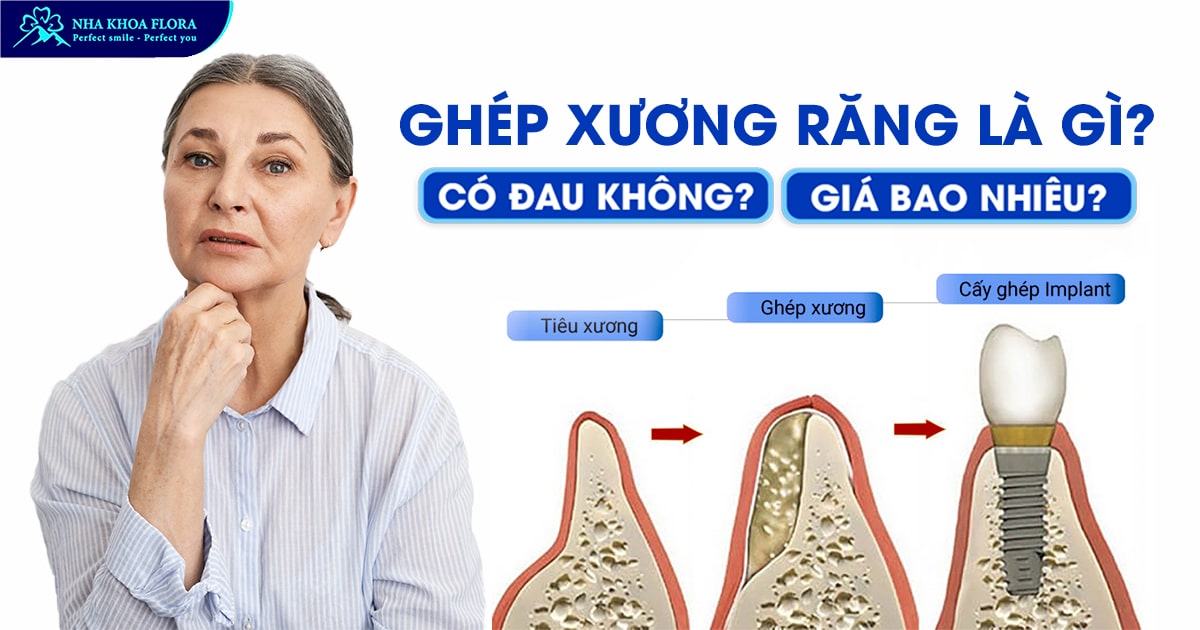 Ghép Xương Răng Là Gì? Có Đau Không? Giá Bao Nhiêu Tiền?