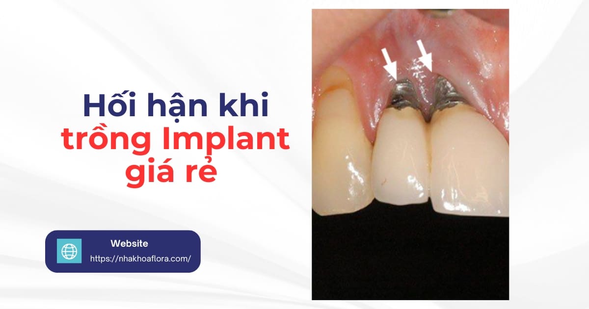 Hối hận khi trồng implant giá rẻ, kém chất lượng
