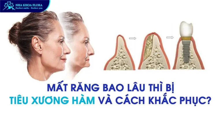 Mất răng bao lâu thì bị tiêu xương hàm và cách khắc phục? 8