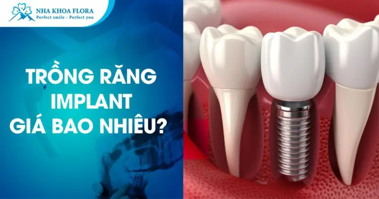 Trồng Răng Implant Giá Bao Nhiêu? - Nha Khoa Flora 3