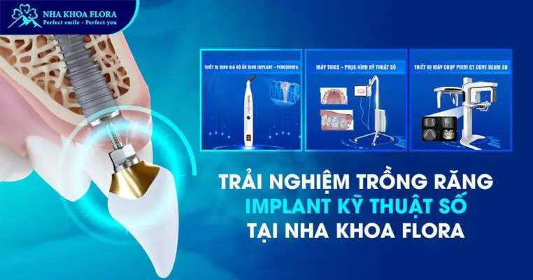 Nha khoa Flora – Đón đầu xu hướng trồng răng Implant kỹ thuật số 6