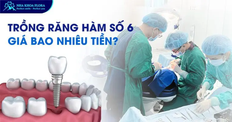 Trồng răng hàm số 6 giá bao nhiêu tiền? 2