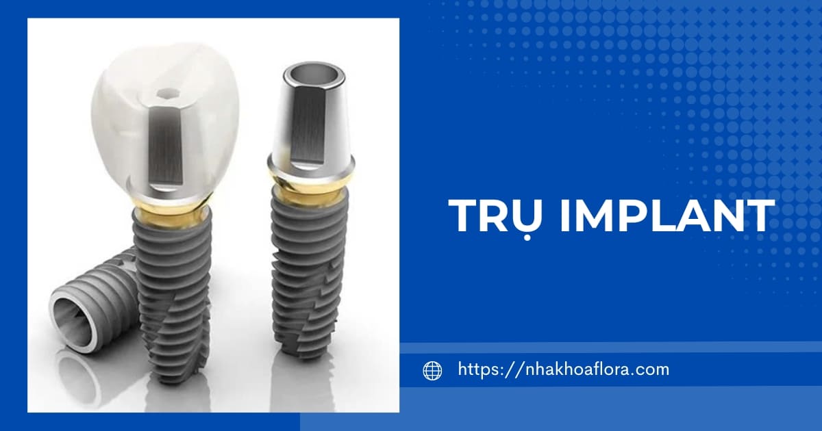 Trụ Implant nào được đánh giá tốt và phổ biến hiện nay?