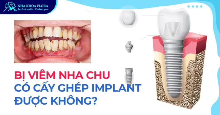 Bị viêm nha chu có cấy ghép Implant được không? 4