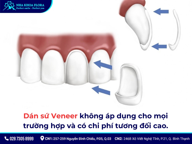 dán sứ veneer có bền không