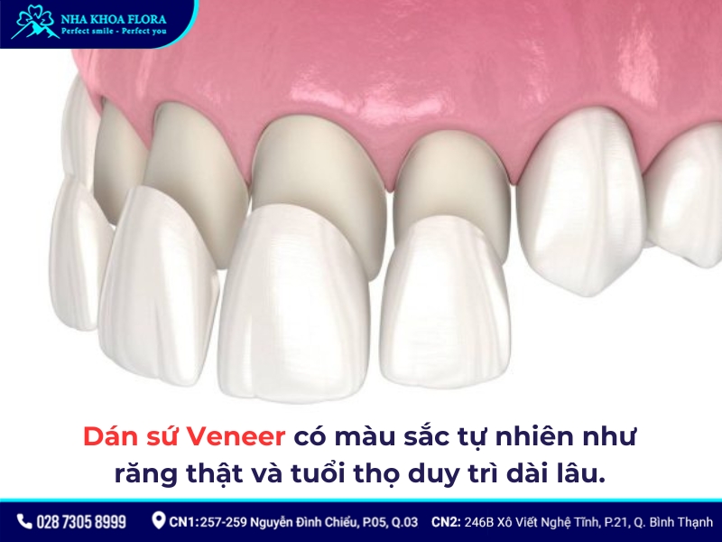 dán sứ veneer có bền không