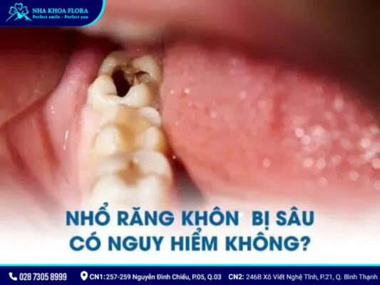 nhổ răng khôn có nguy hiểm không - ảnh 6 nhổ răng khôn có nguy hiểm không - ảnh 6