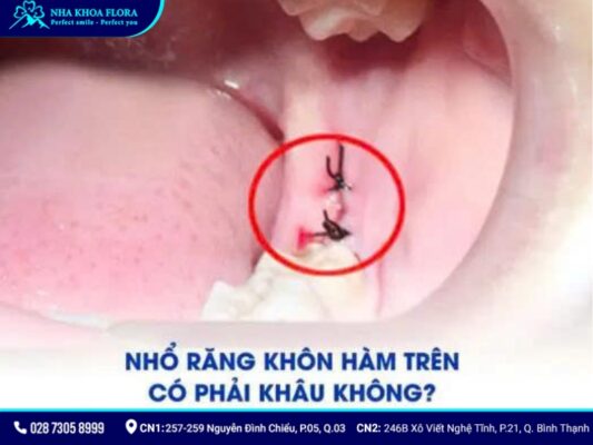 nhổ răng khôn hàm trên - ảnh 4 nhổ răng khôn hàm trên - ảnh 4