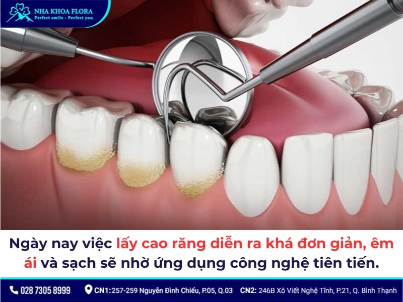 cạo vôi răng