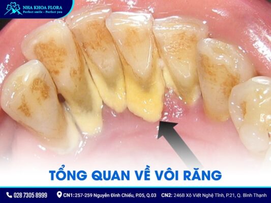 cạo vôi răng có làm trắng răng không - ảnh 1 cạo vôi răng có làm trắng răng không - ảnh 1