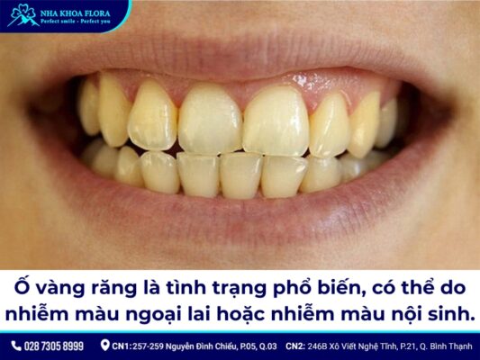 tẩy trắng răng có hại không - ảnh 1