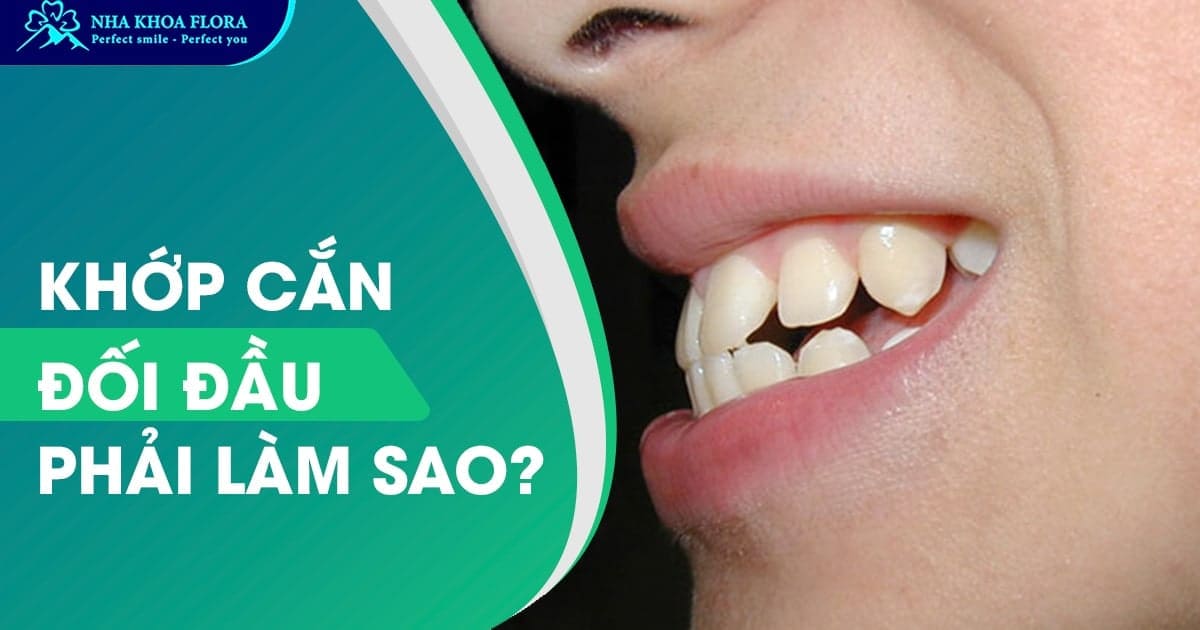 Khớp cắn đối đầu là gì? Tác hại và Cách điều trị