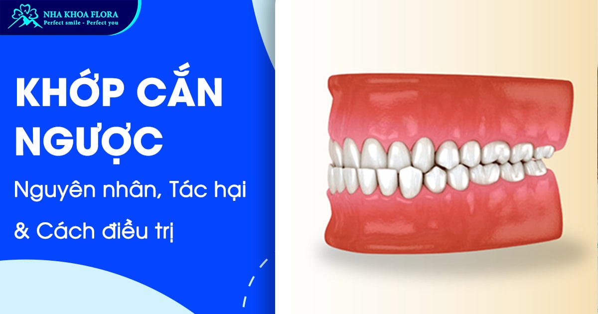 Top 3 cách điều trị khớp cắn ngược hiệu quả