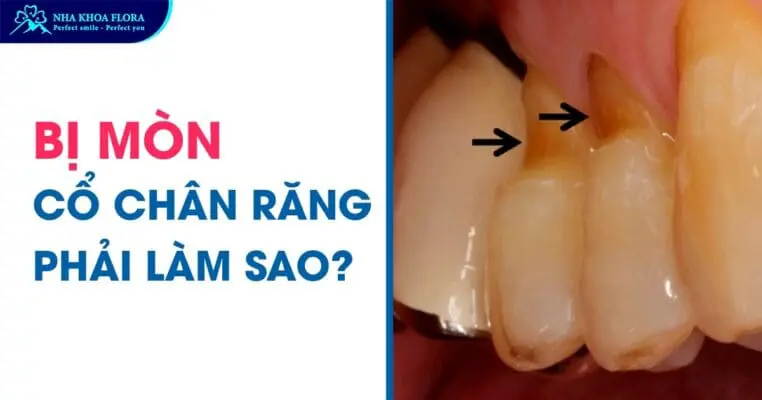 Bị mòn cổ chân răng phải làm sao? 1